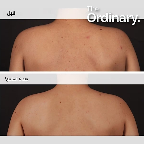 سيروم للجسم بحمض الساليسيليك 0.5%، 240 مل
