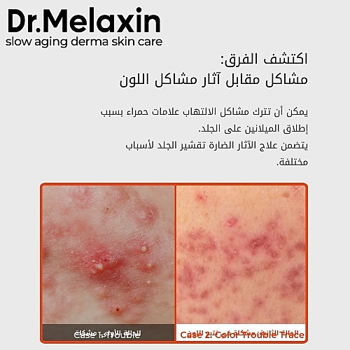 قناع ورقي لإصلاح الإكسوسومات (قطعة واحدة)