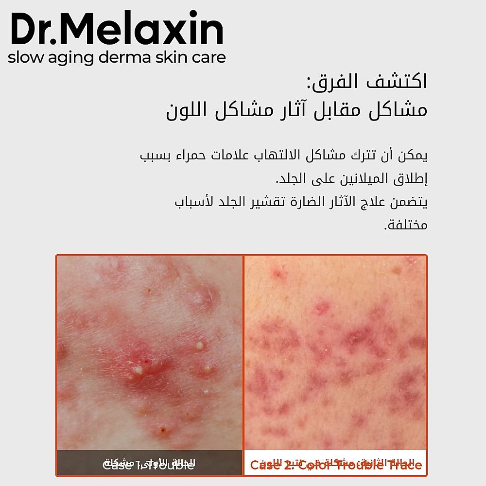 قناع ورقي لإصلاح الإكسوسومات (قطعة واحدة)