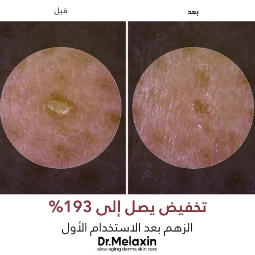 أمبولة مقشرة من الأرز الأسود