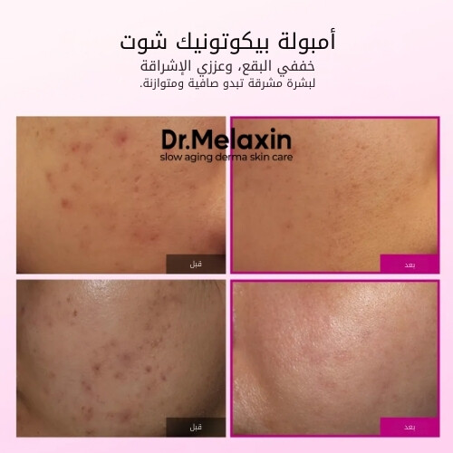 أمبولات سيمينريت بيكوتونيك شوت 30 مل