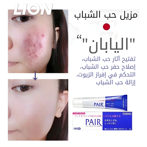 كريم ليون لعلاج حب الشباب 24 غرام