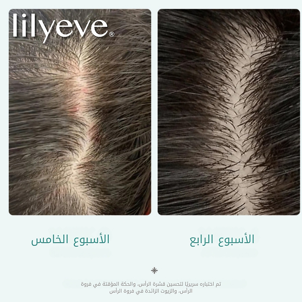 فرشاة علاج فروة الرأس: أمبولة تيرن سيكا بي دي آر إن 100 مل