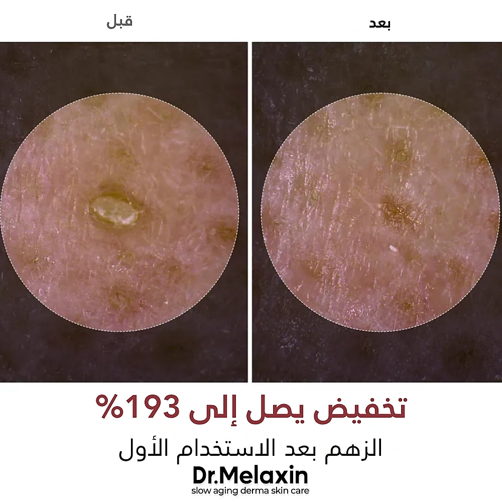 أمبولة مقشرة من الأرز الأسود