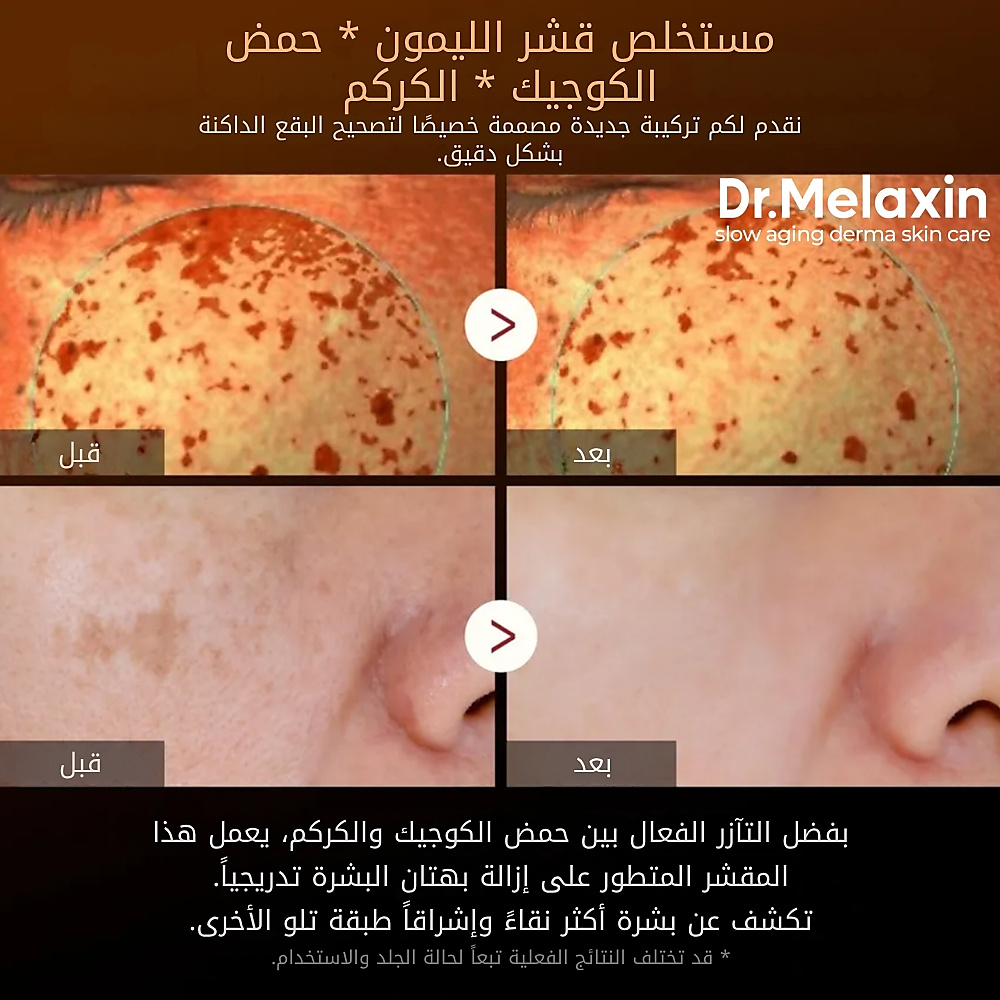 سيروم التقشير بحمض الكوجيك والكركم من بيل شوت