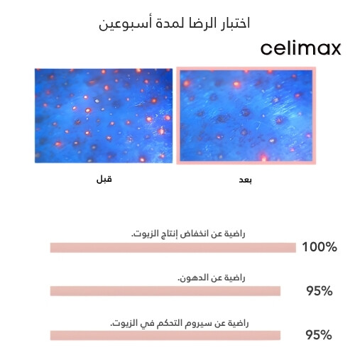 خلاصة كبسولة التحكم بالزيت 30 مل