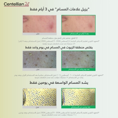 مسحوق شجرة الشاي ماديكا AC 6 جرام