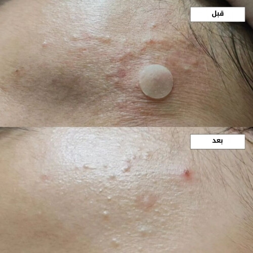 سيروم حمض الأزيليك A-Control 10% 30 مل