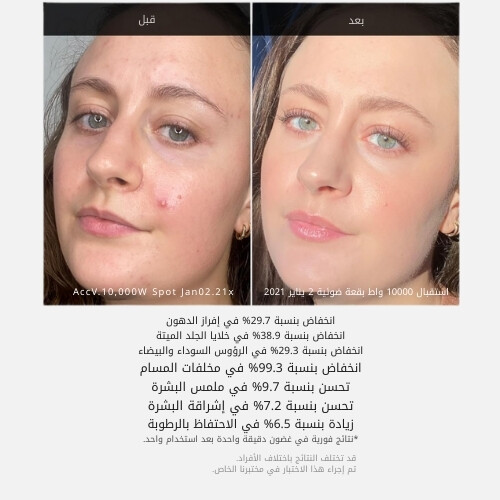 مقشر حمض السكسينيك لعلاج حب الشباب الأحمر 40 غرام