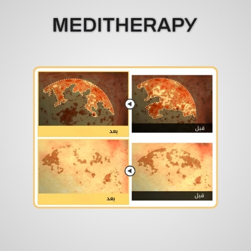 كريم ميلاجوران وايت لتفتيح البشرة 50 مل وجهاز EMS لتفتيح البشرة ومكافحة البقع