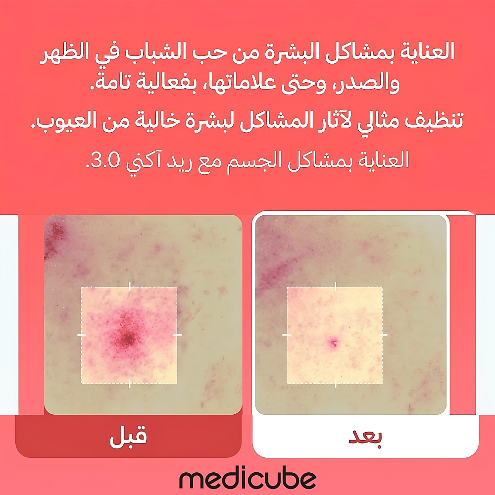 غسول الجسم "ريد" (Red) لعلاج حب الشباب 2.0 - 400 مل (إصدار مُجدَّد)