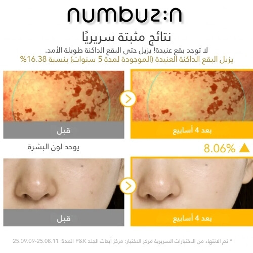 أمبولة مُركّزة مُتقدّمة من الجلوتاثيون TXA رقم 5 للبقع الداكنة