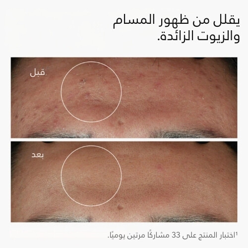 نياسيناميد 10% + زنك 1%