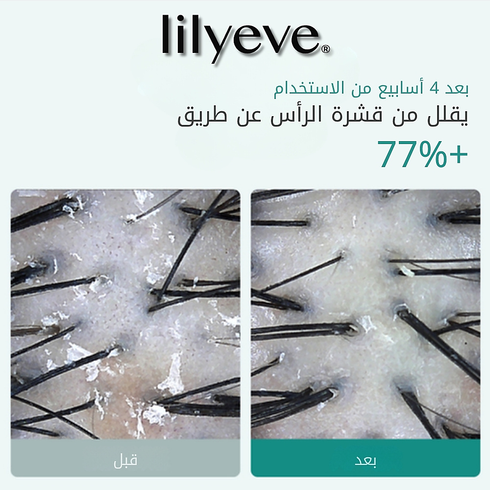 فرشاة علاج فروة الرأس: أمبولة تيرن سيكا بي دي آر إن 100 مل