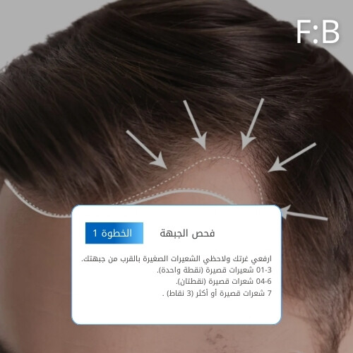 أمبولات فروة الرأس MTS 300 بلو بوست 10 مل