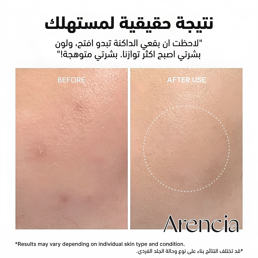 جرعة معززة من حمض الترانيكساميك 30 مل