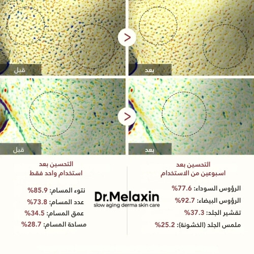 أمبولة مقشرة من الأرز الأسود