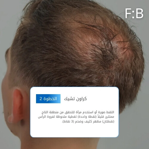 أمبولات فروة الرأس MTS 300 بلو بوست 10 مل