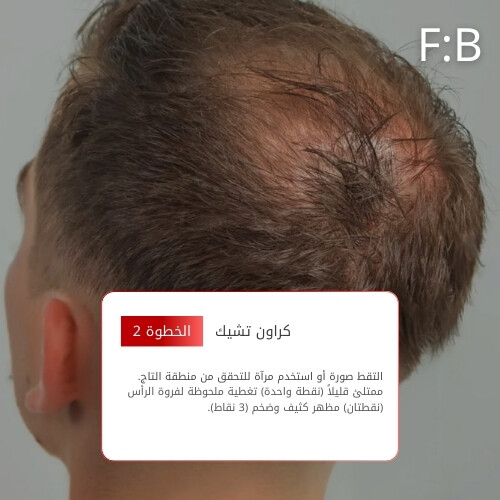 أمبولات فروة الرأس MTS 500 ريد بوست 10 مل