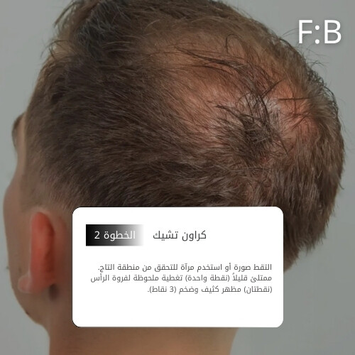 أمبولات فروة الرأس MTS 1000 بلاك بوست 10 مل