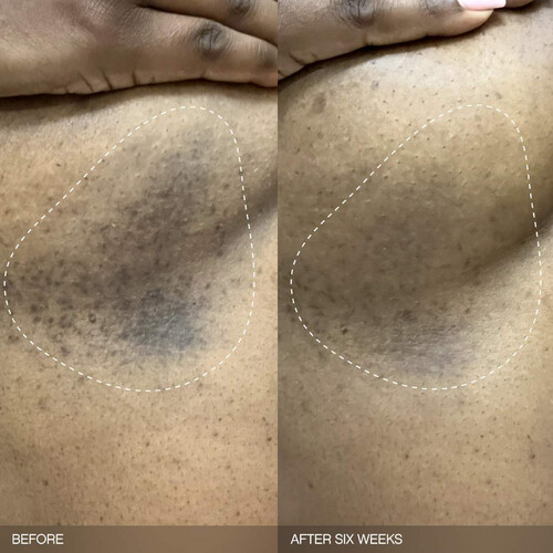 Faded Brightening Bundle for Discoloration on Face & Body (UNSCENTED)